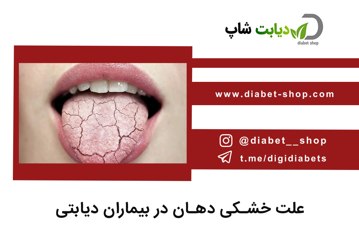علت خشکی دهان در بیماران دیابتی