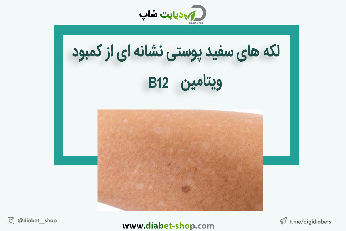لکه های سفید پوستی نشانه ای از کمبود ویتامین B12