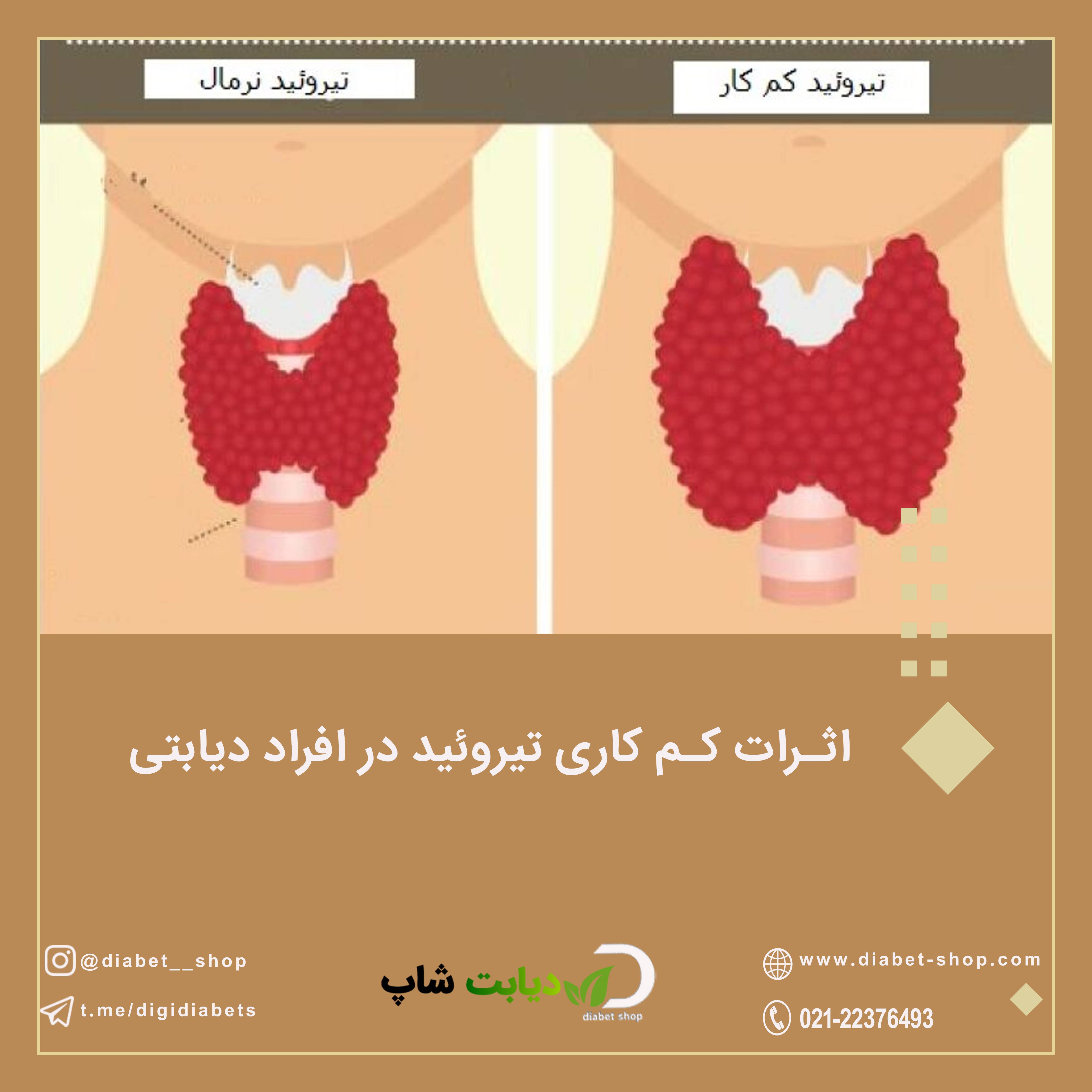 اثرات کم کاری تیروئید در افراد دیابتی