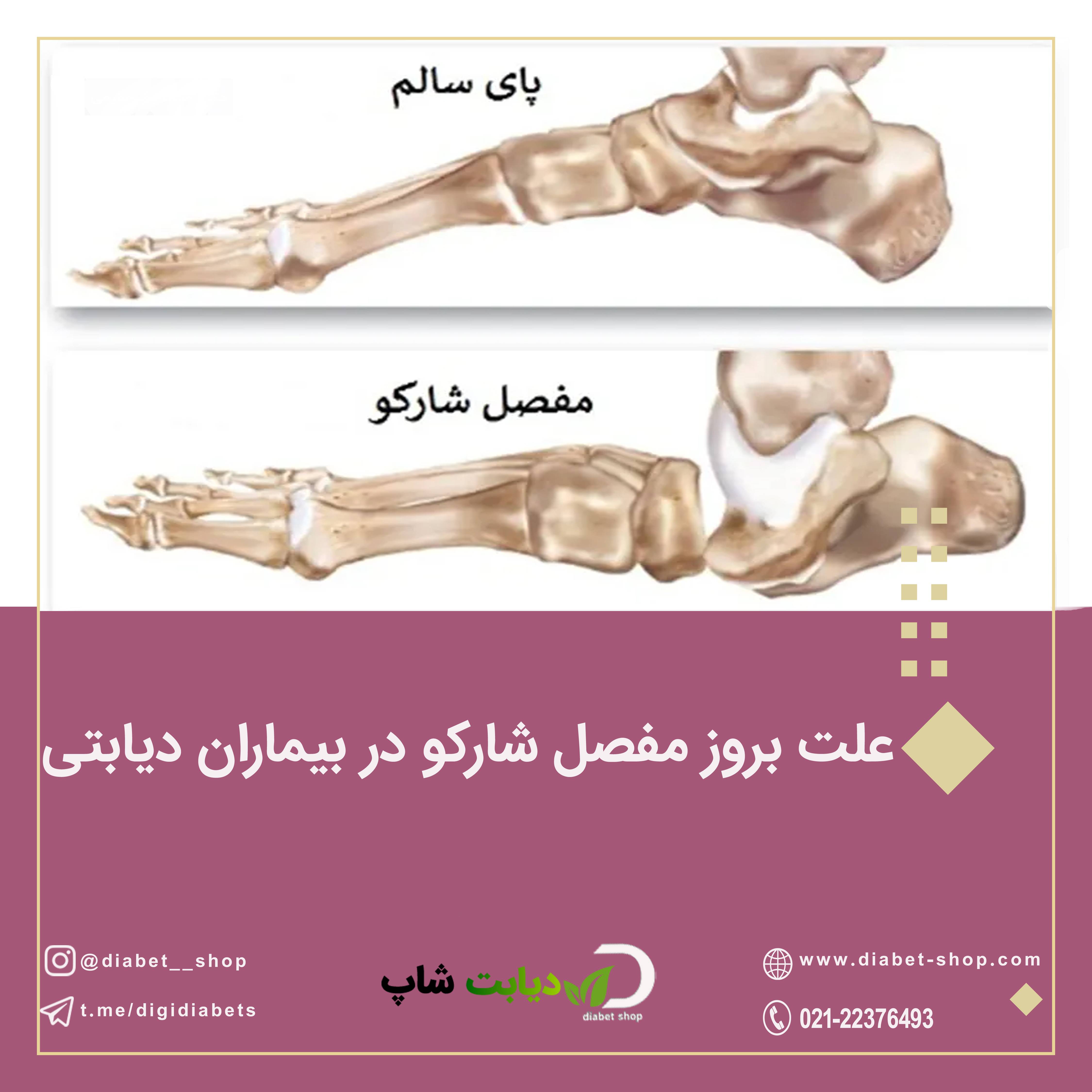 علت بروز مفصل شارکو در بیماران دیابتی