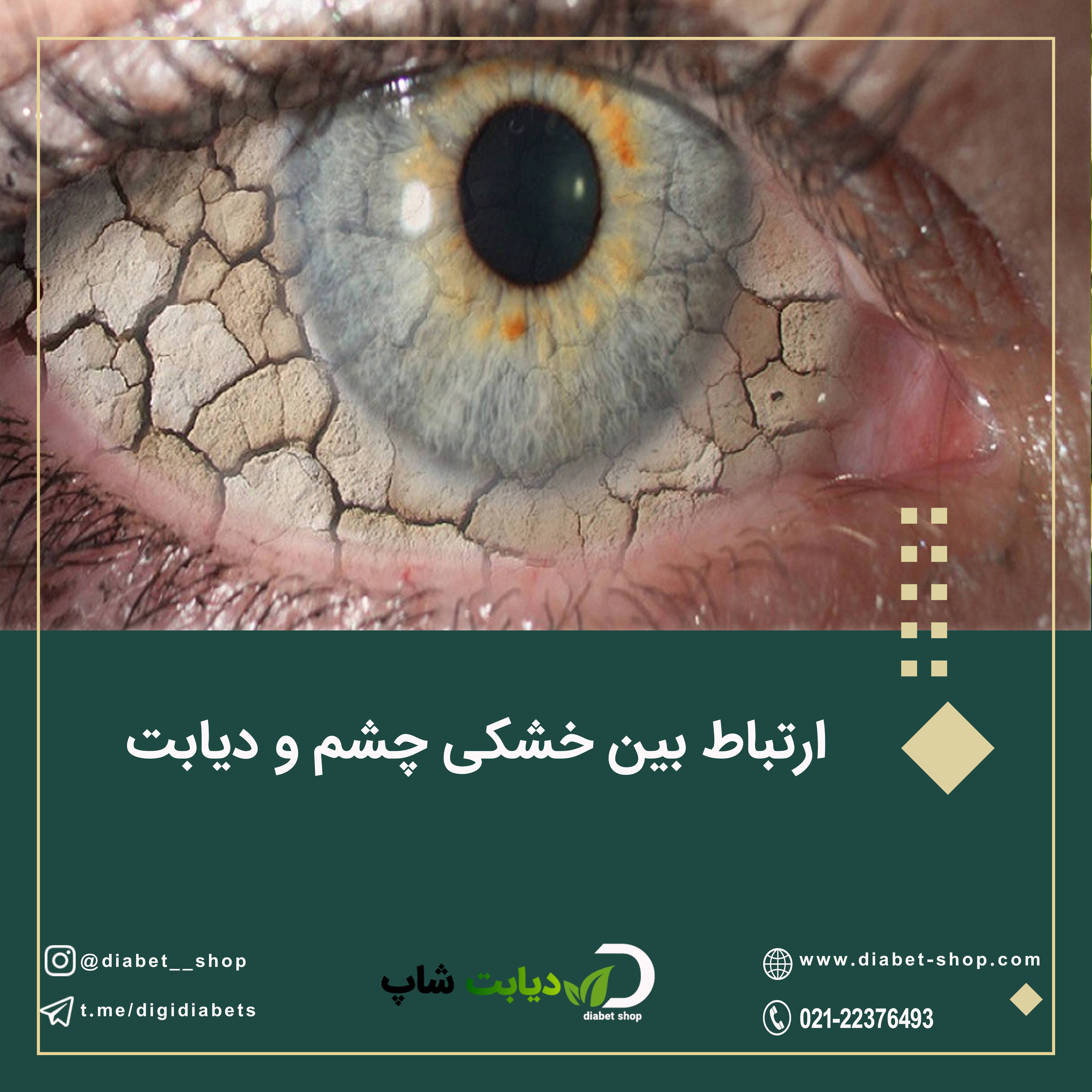 ارتباط بین خشکی چشم و دیابت