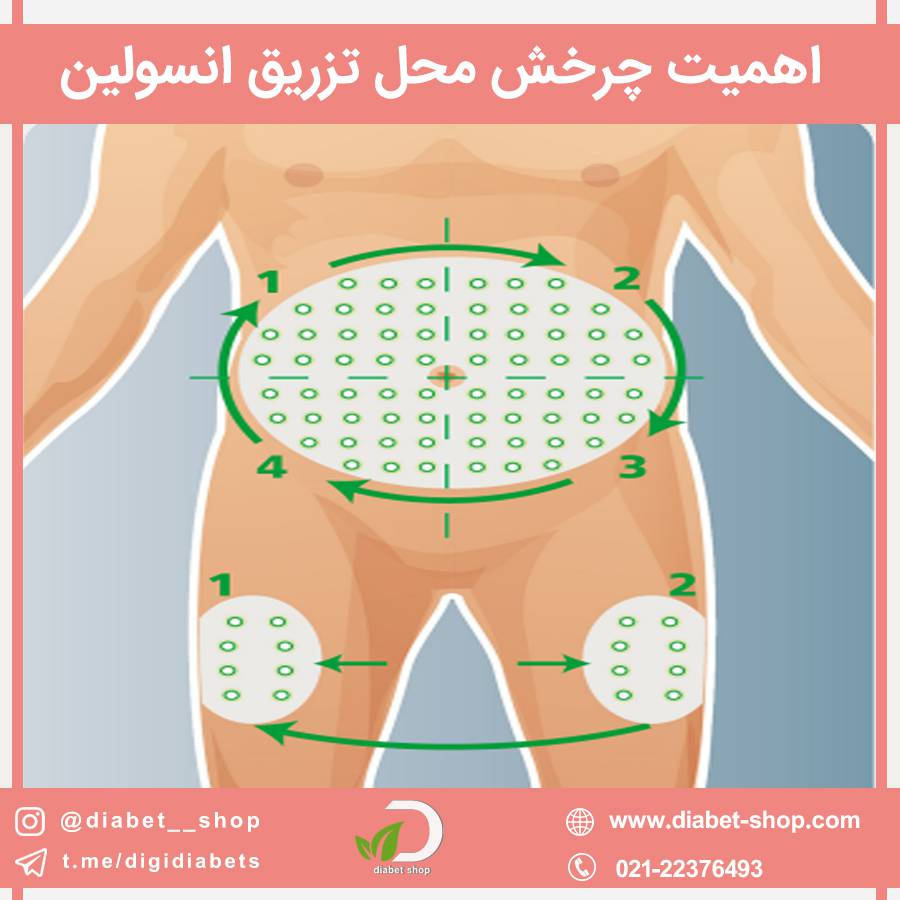 اهمیت چرخش محل تزریق انسولین