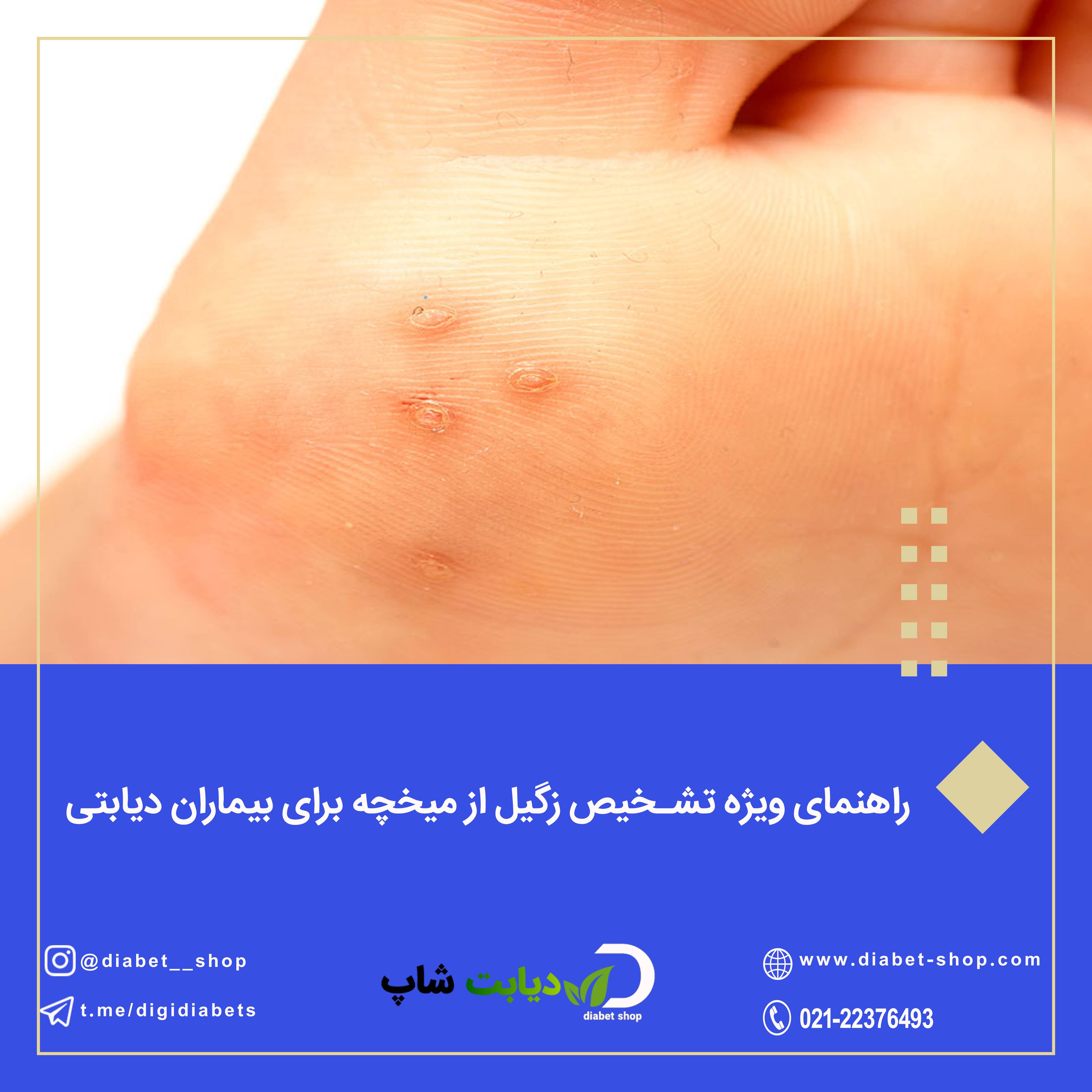 راهنمای ویژه تشخیص زگیل از میخچه برای بیماران دیابتی