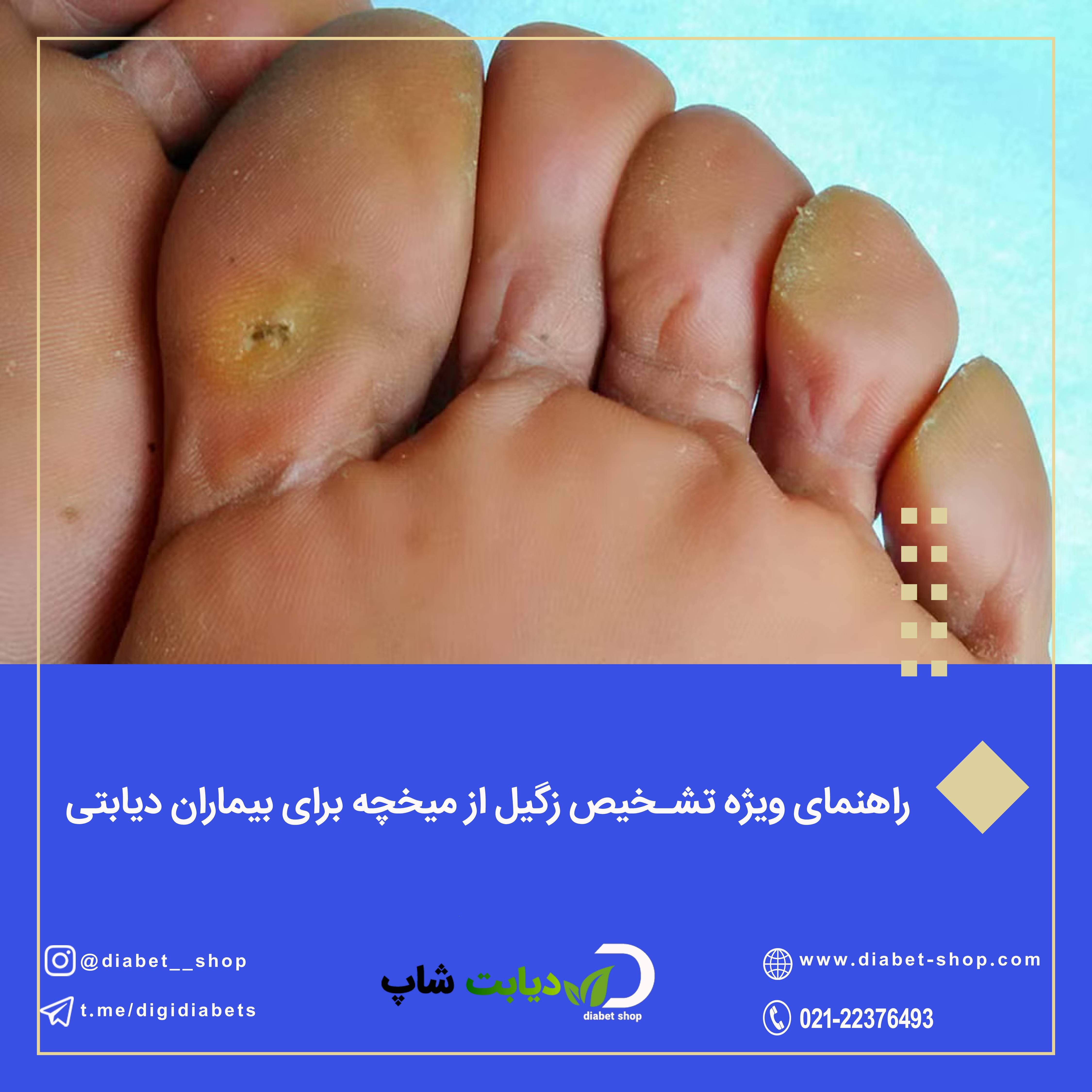 راهنمای ویژه تشخیص زگیل از میخچه برای بیماران دیابتی