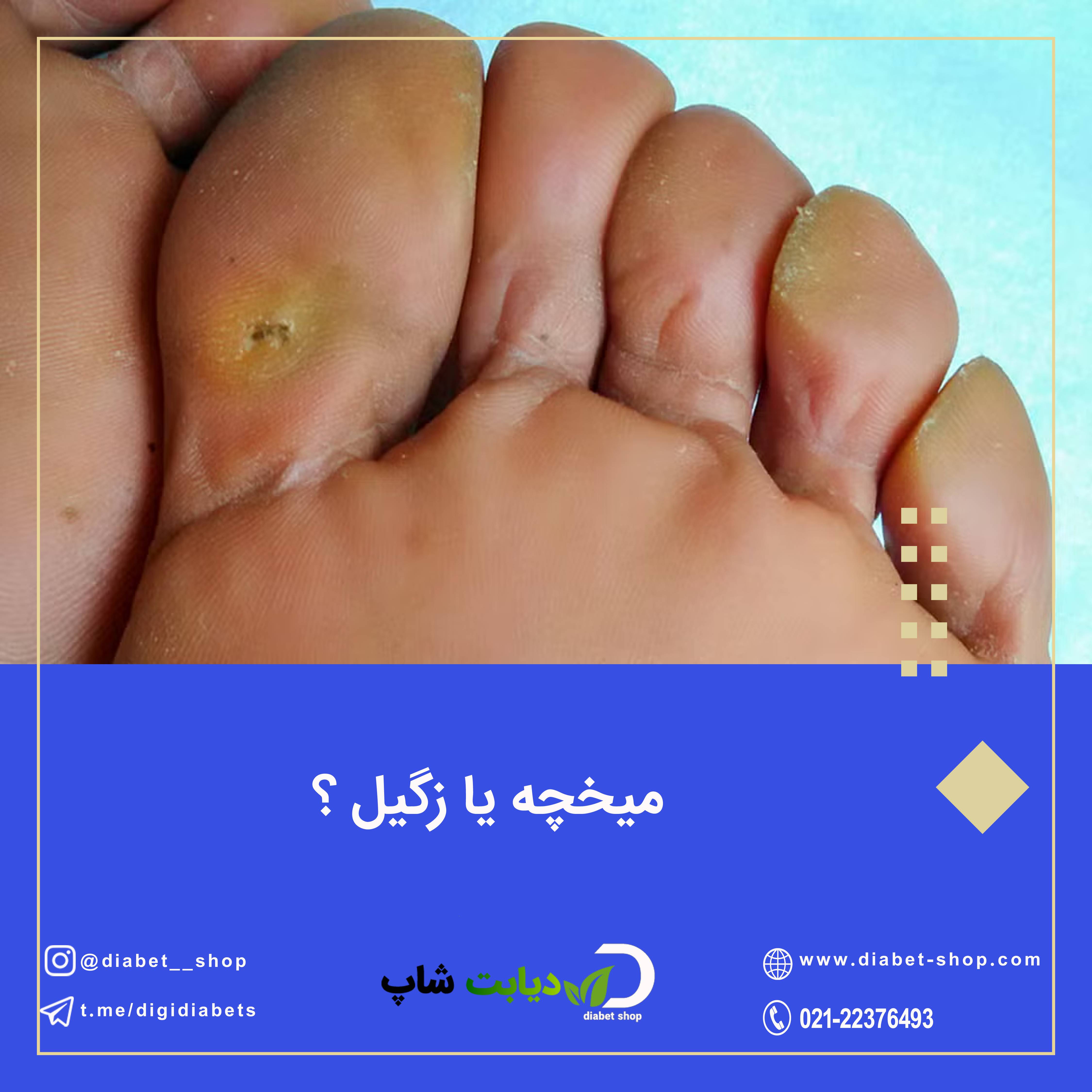 میخچه یا زگیل 