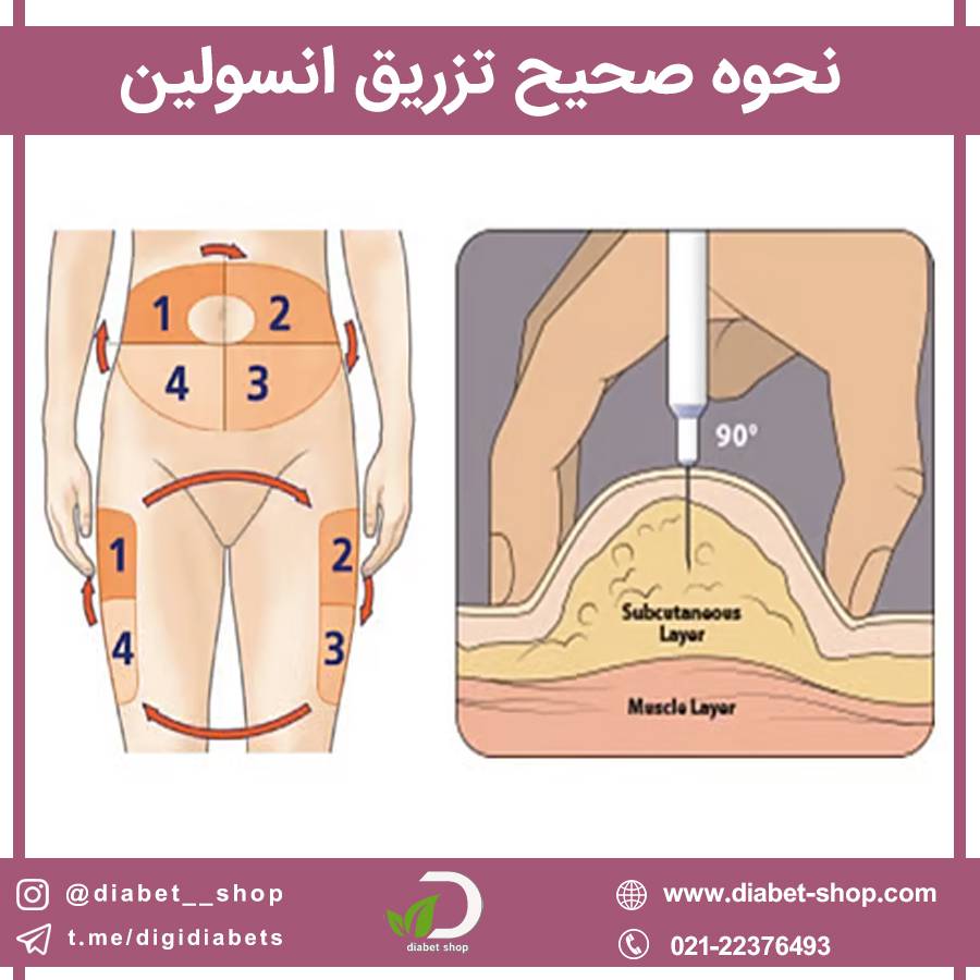 نحوه صحیح تزریق انسولین