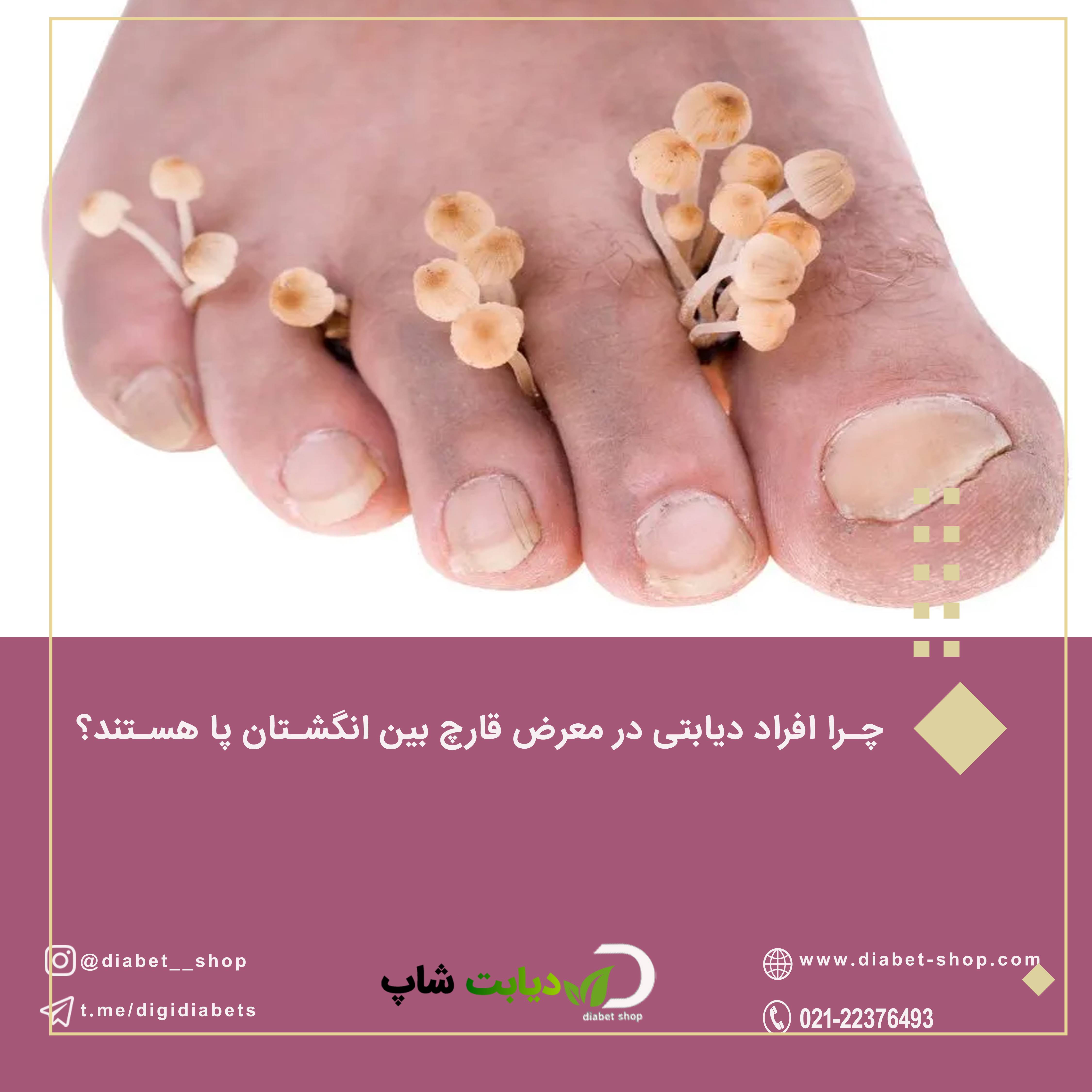 چرا افراد دیابتی در معرض قارچ بین انگشتان پا هستند