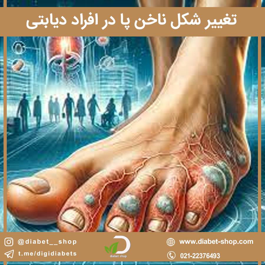 تغییر شکل ناخن پا در افراد دیابتی
