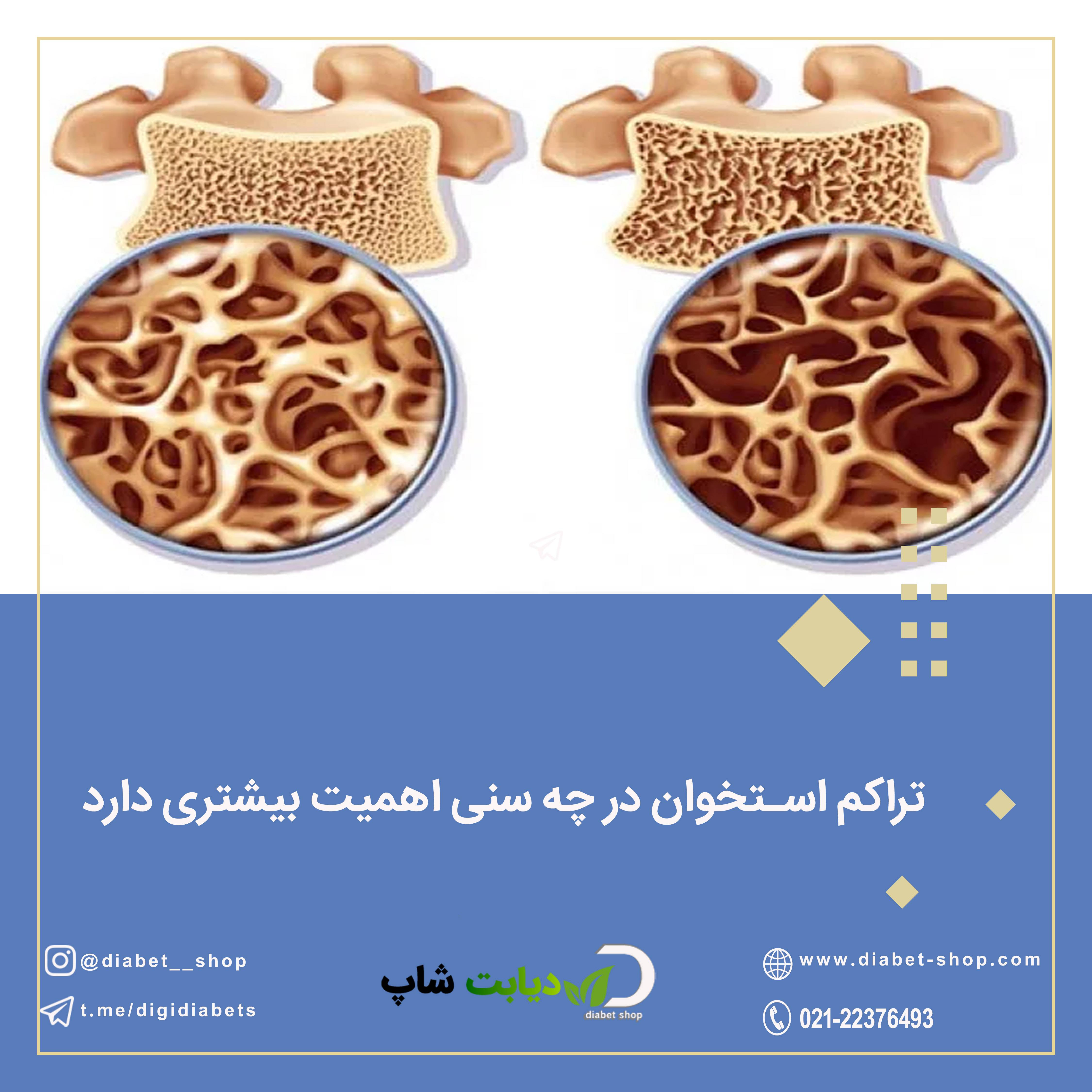 تراکم استخوان در چه سنی اهمیت بیشتری دارد