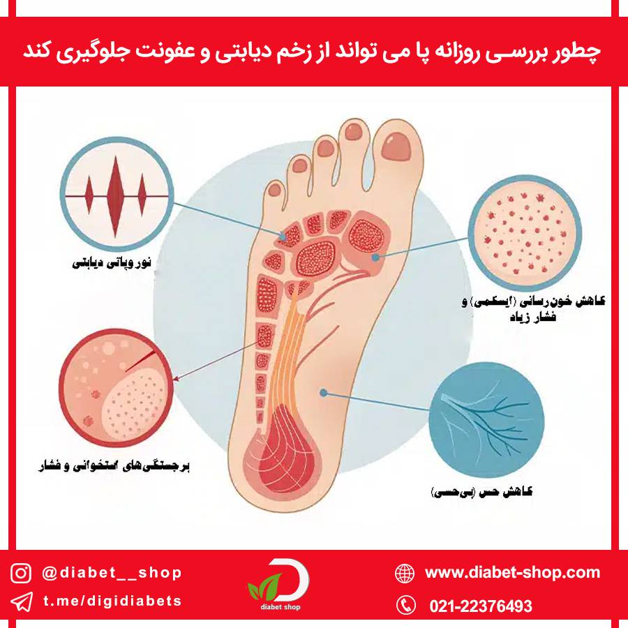 چطور بررسی روزانه پا می تواند از زخم دیابتی و عفونت جلوگیری کند