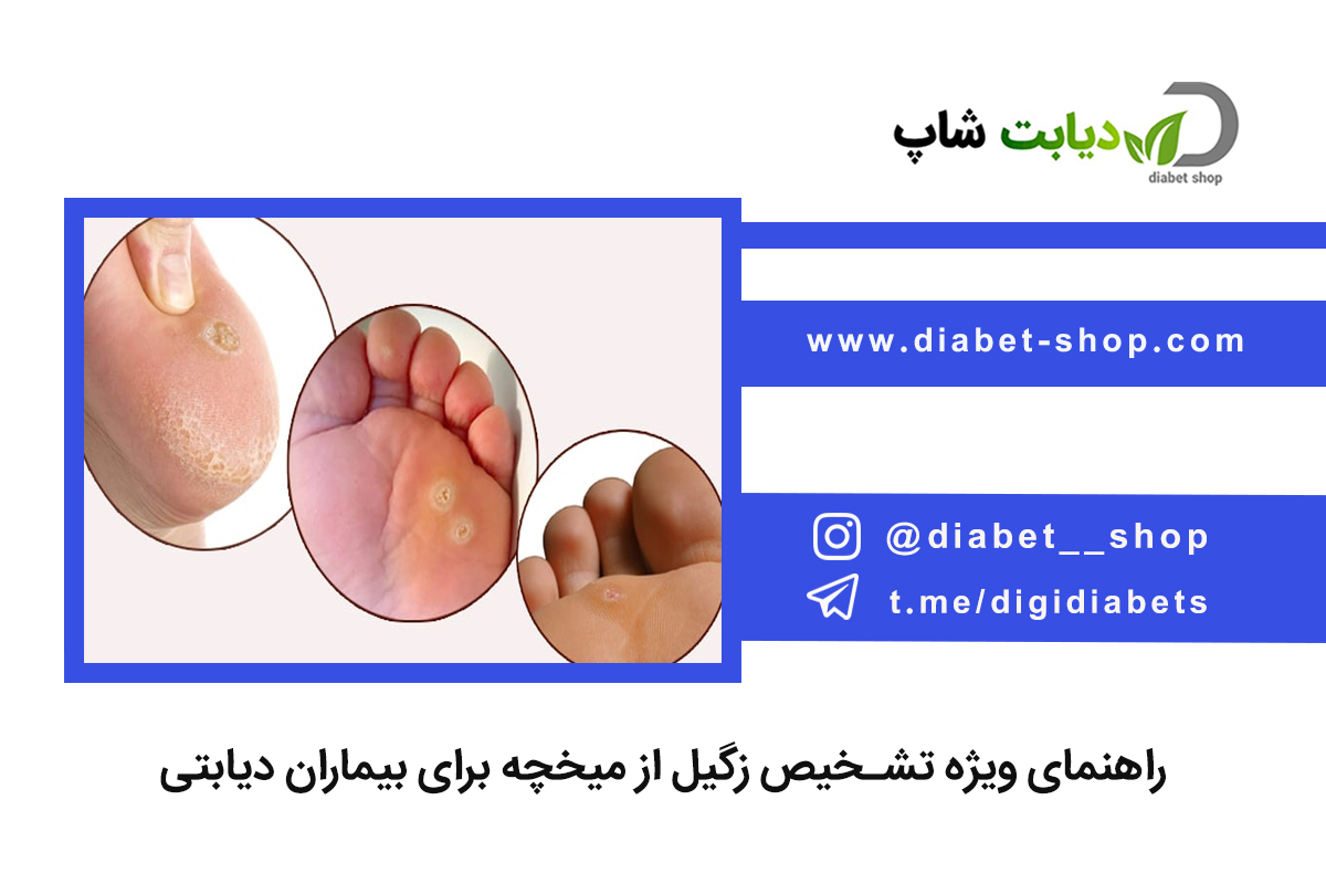راهنمای ویژه تشخیص زگیل از میخچه برای بیماران دیابتی