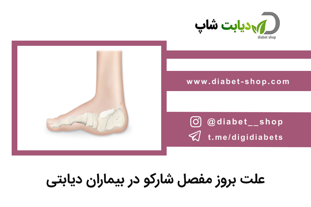 علت بروز مفصل شارکو در بیماران دیابتی