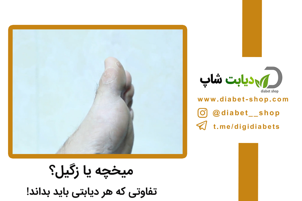میخچه یا زگیل